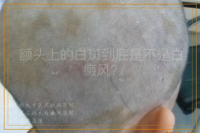 额头上的白斑到底是不是白癜风？