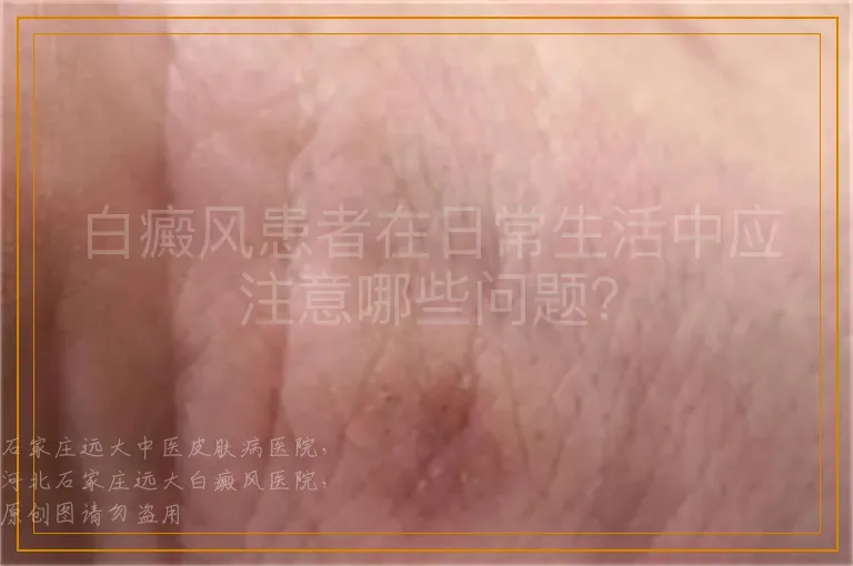 白癜风患者在日常生活中应注意哪些问题？