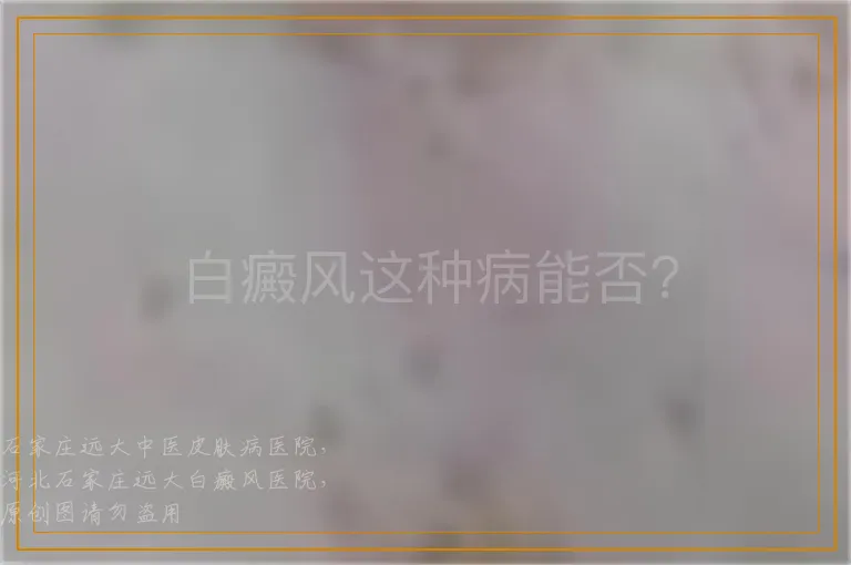 白癜风这种病能否？