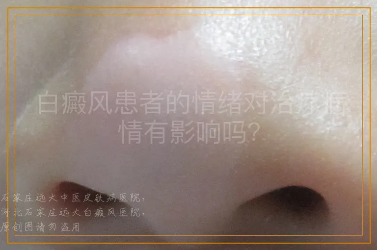 白癜风患者的情绪对治疗病情有影响吗？