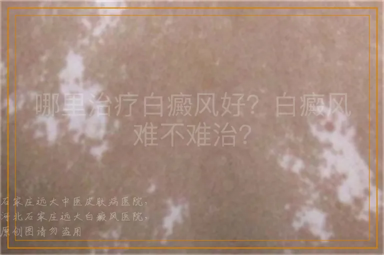 哪里治疗白癜风好？白癜风难不难治？