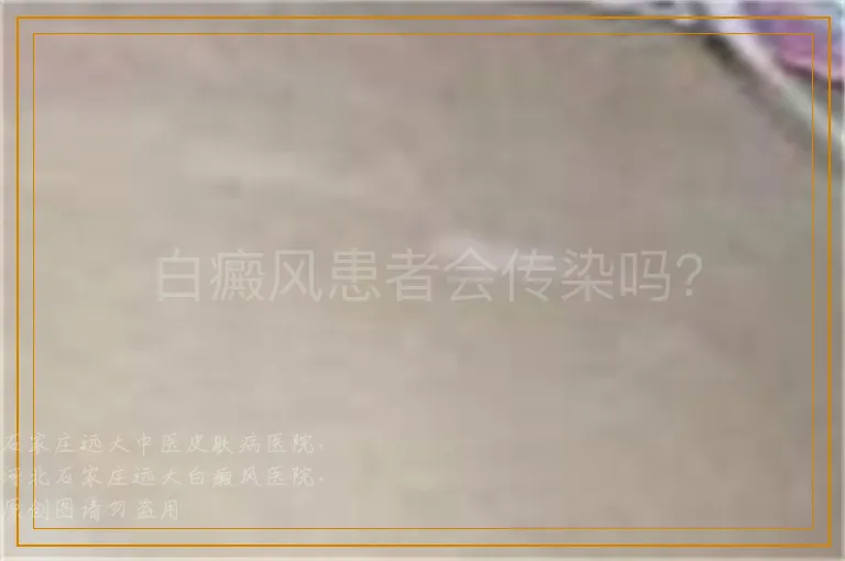 白癜风患者会传染吗？