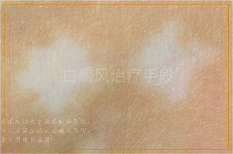 白癜风治疗手段