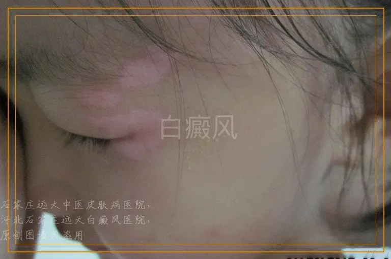 白癜风