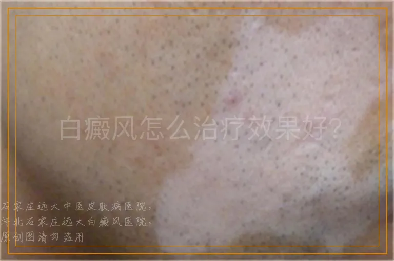 白癜风怎么治疗效果好？