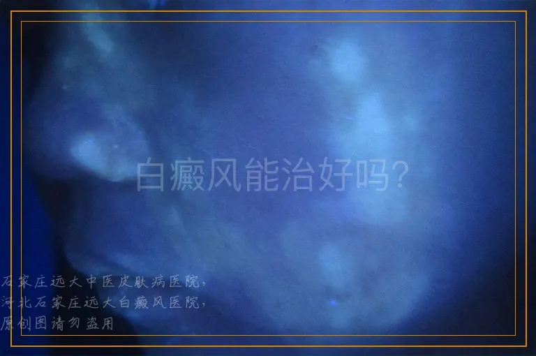 白癜风能治好吗？