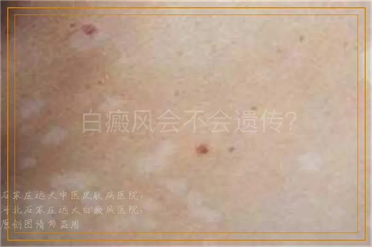 白癜风会不会遗传？
