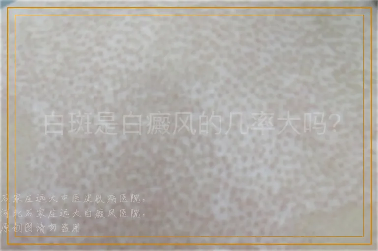 白斑是白癜风的几率大吗？
