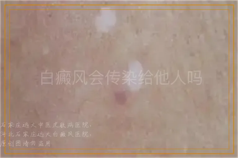 白癜风会传染给他人吗