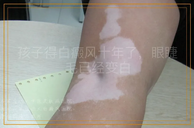 孩子得白癜风十年了，眼睫毛已经变白