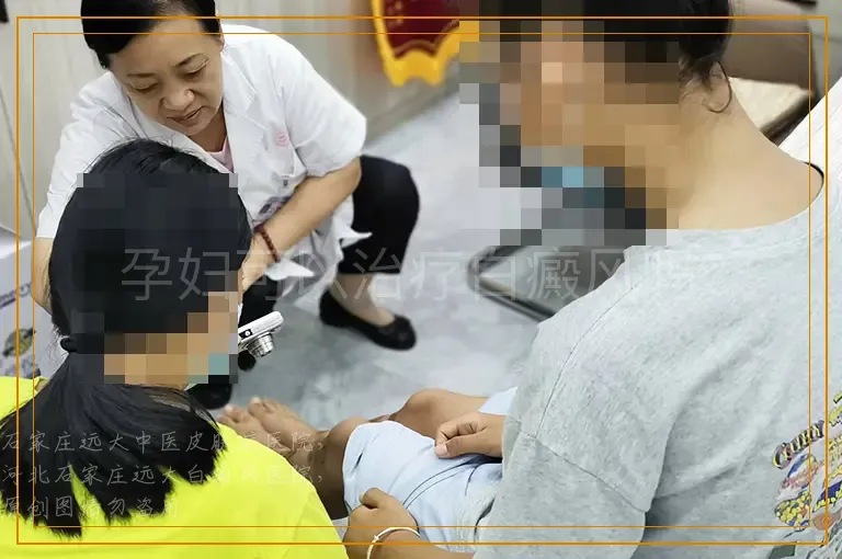 孕妇可以治疗白癜风吗？