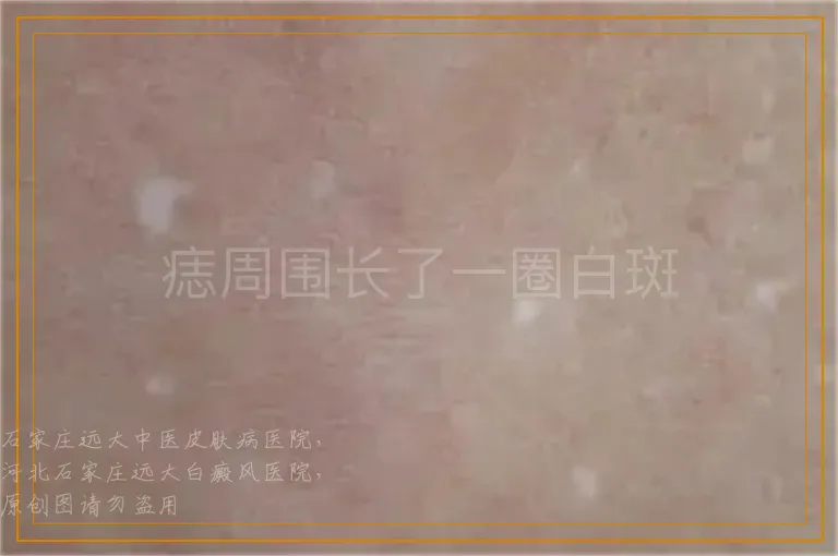 痣周围长了一圈白斑