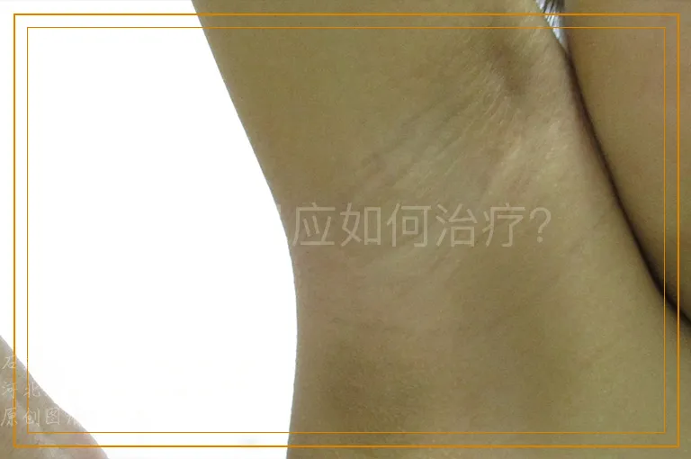 白癜风应如何治疗？