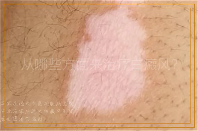 从哪些方面来治疗白癜风？