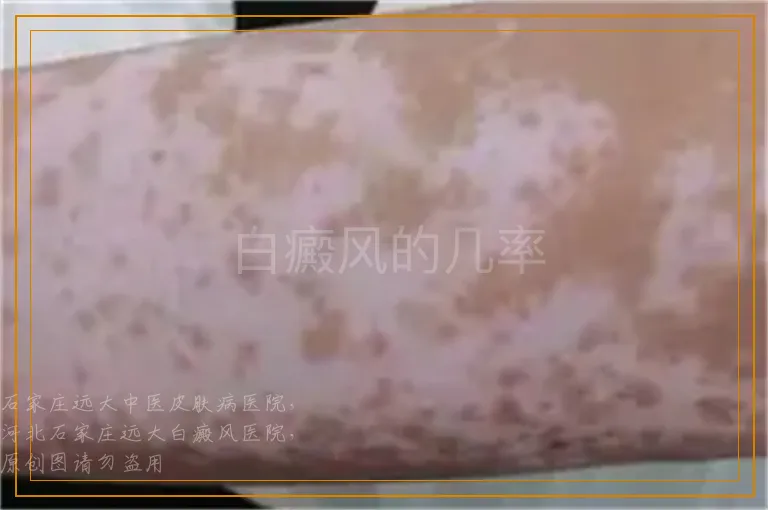 白癜风的几率