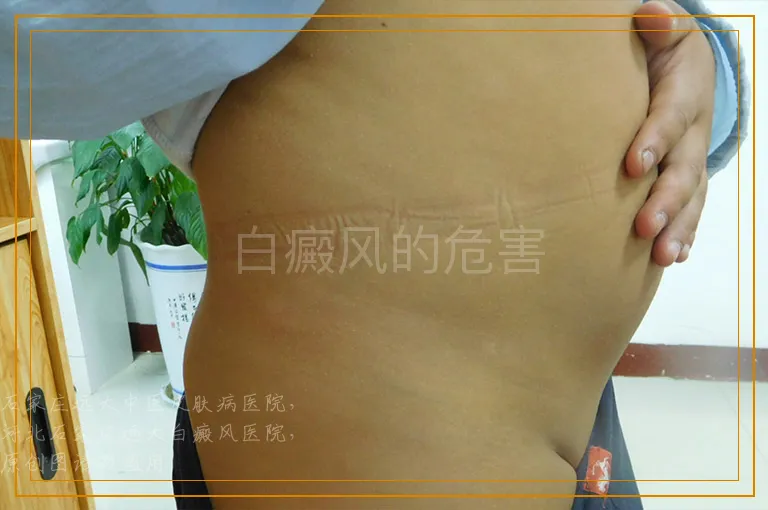 白癜风的危害