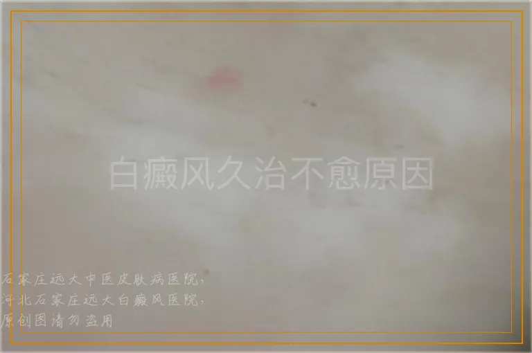 白癜风久治不愈原因