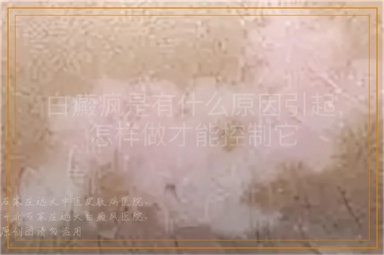 白癜疯是有什么原因引起，怎样做才能控制它
