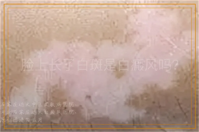 脸上长了白斑是白癜风吗？