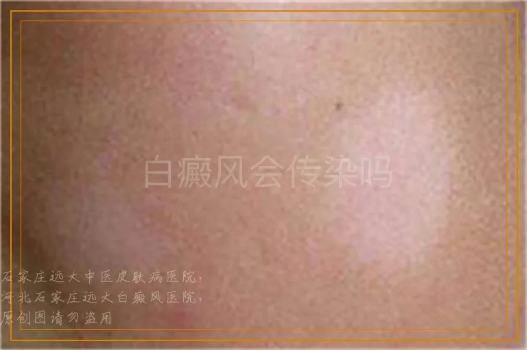 白癜风会传染吗