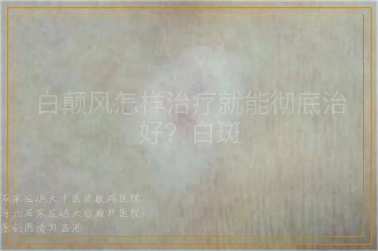 白颠风怎样治疗就能彻底治好？白斑