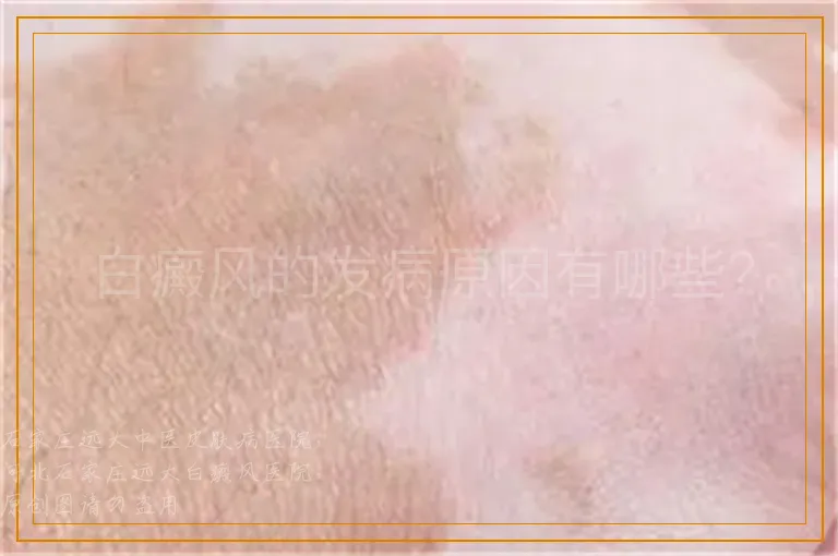 白癜风的发病原因有哪些？