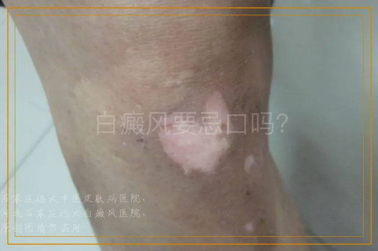 白癜风要忌口吗？