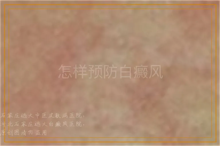 怎样预防白癜风