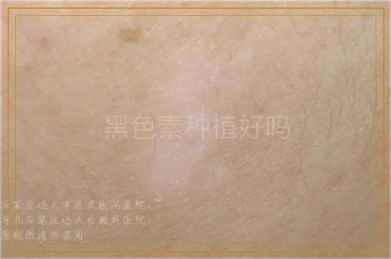 黑色素种植好吗