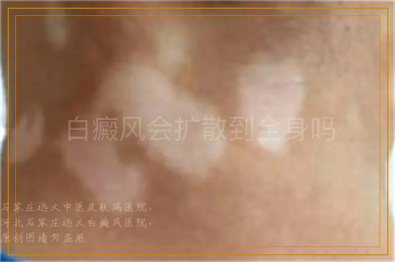 白癜风会扩散到全身吗