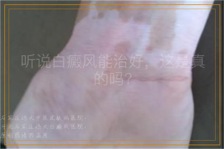 听说白癜风能治好，这是真的吗？