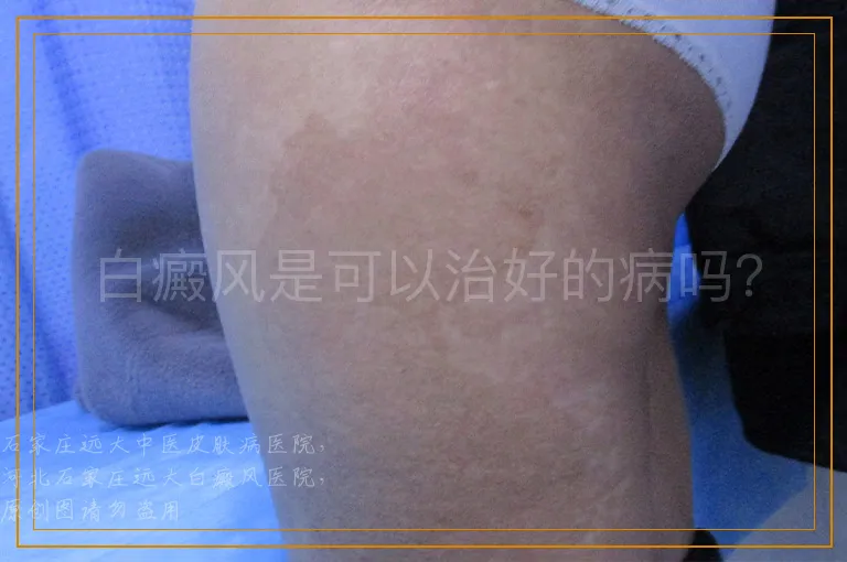 白癜风是可以治好的病吗？