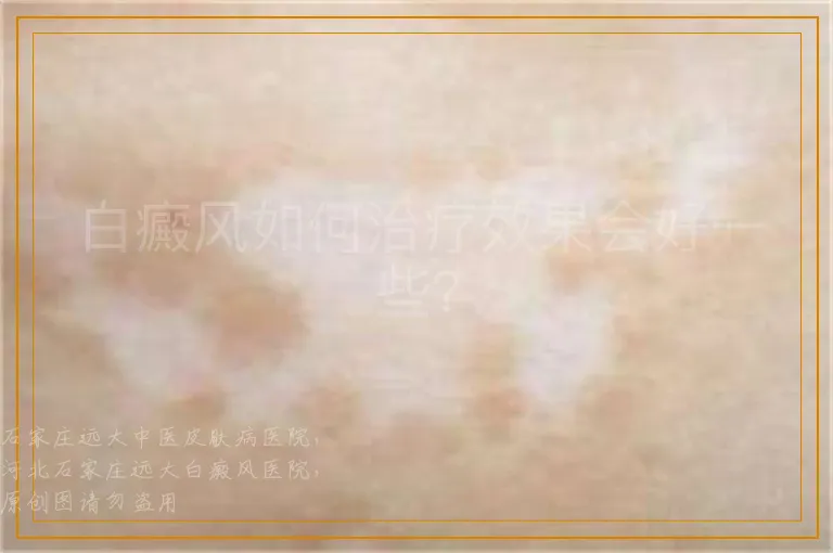 白癜风如何治疗效果会好一些？