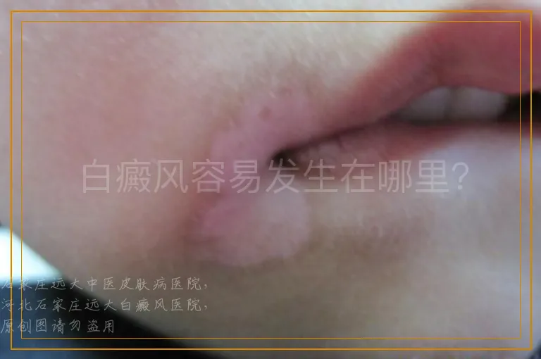 白癜风容易发生在哪里？
