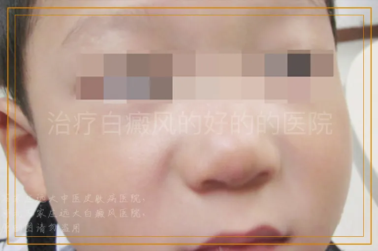 治疗白癜风的好的的医院