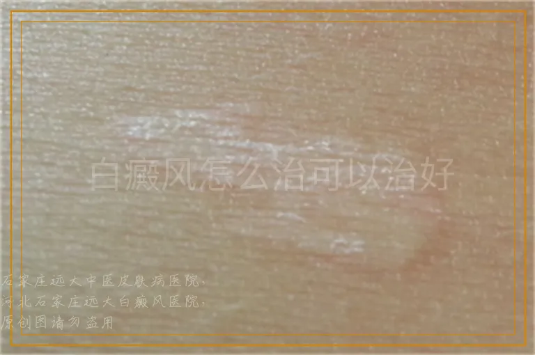 白癜风怎么治可以治好