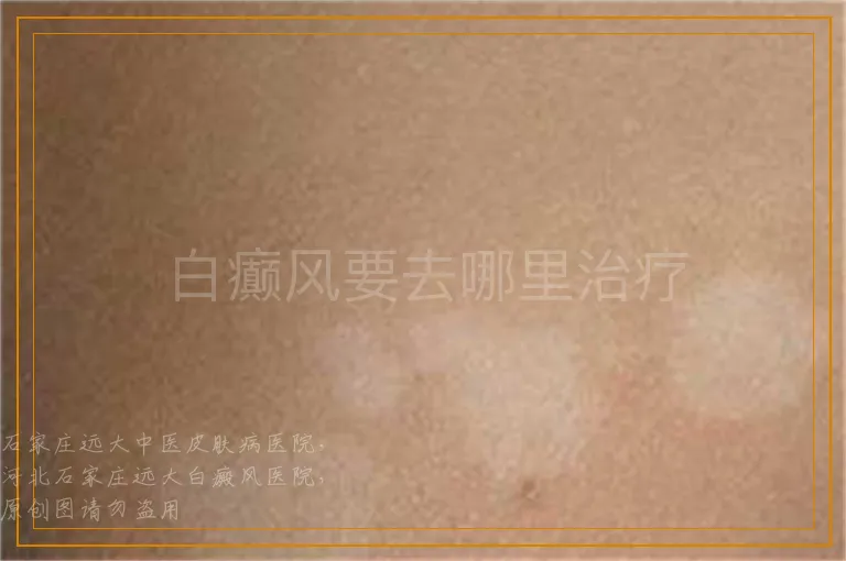 白癫风要去哪里治疗