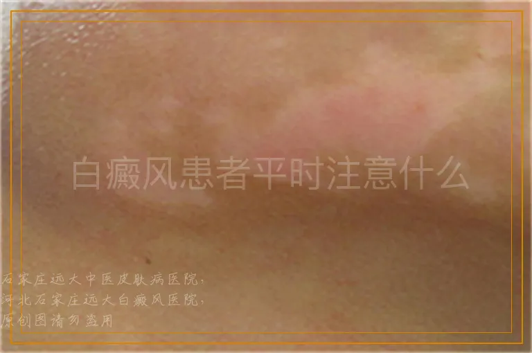 白癜风患者平时注意什么
