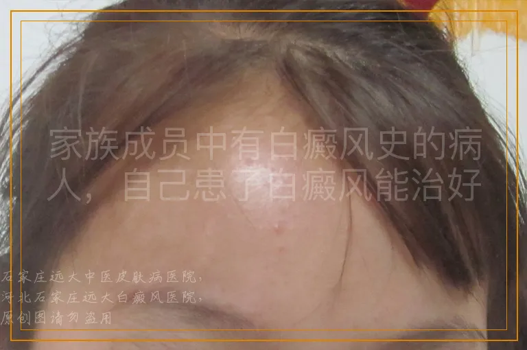 家族成员中有白癜风史的病人，自己患了白癜风能治好吗？