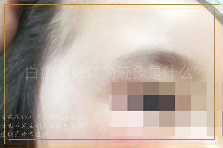 白癜风好转的迹象是什么?