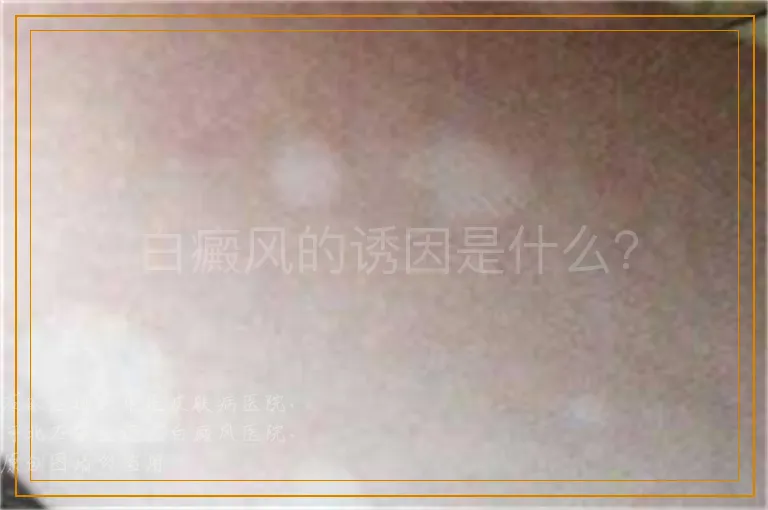 白癜风的诱因是什么？