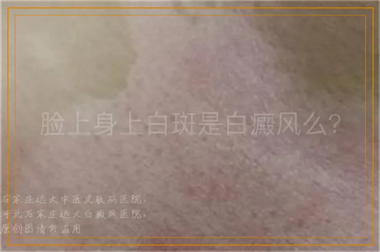 脸上身上白斑是白癜风么？