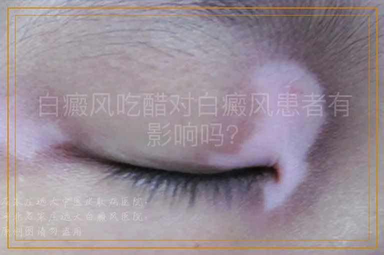 白癜风吃醋对白癜风患者有影响吗？