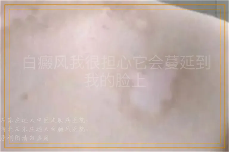 白癜风我很担心它会蔓延到我的脸上