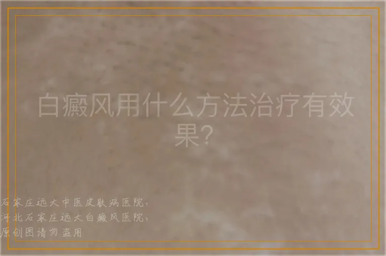 白癜风用什么方法治疗有效果？
