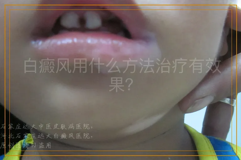 白癜风用什么方法治疗有效果？
