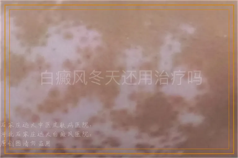 白癜风冬天还用治疗吗