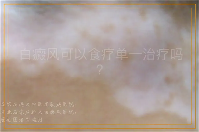 白癜风可以食疗单一治疗吗？