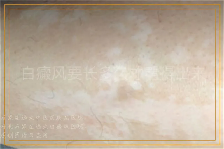 白癜风要长多久才看得出来