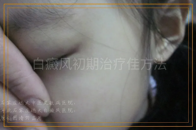 白癜风初期治疗佳方法